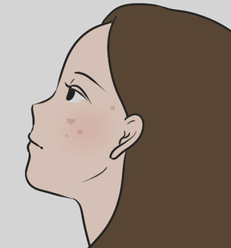 シミが濃くなる